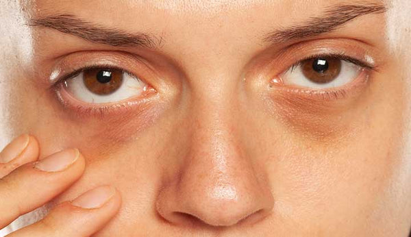 Natural remedies to reduce dark circles
