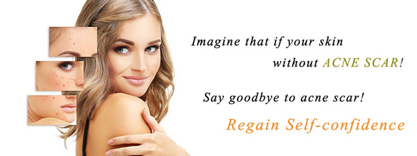 The Best and Safe Ways to Remove Acne Scars!