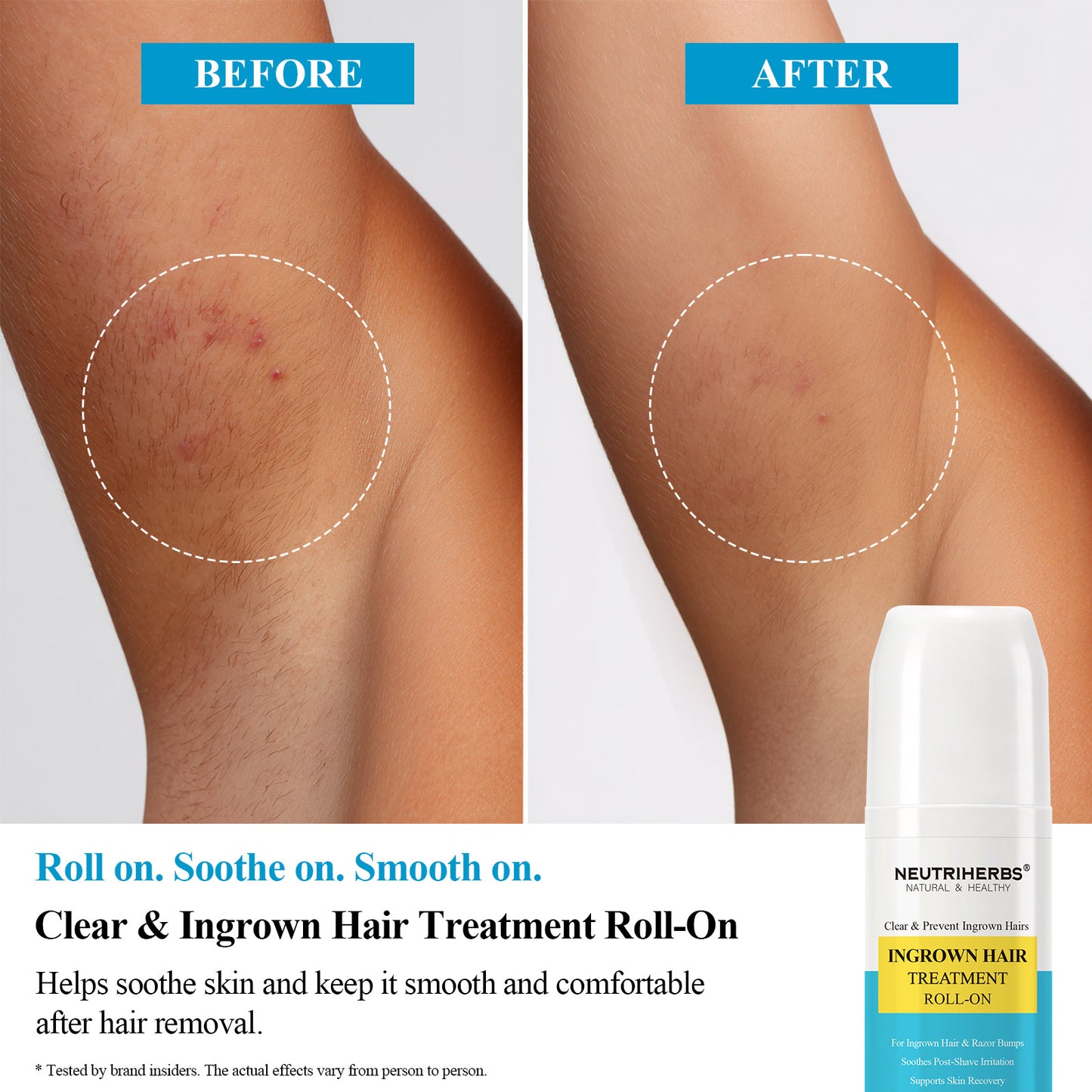 Private Label & Wholesale Clear & Ingrown Hair Treatment Roll-On For Ingrown Hair & Razor Bumps