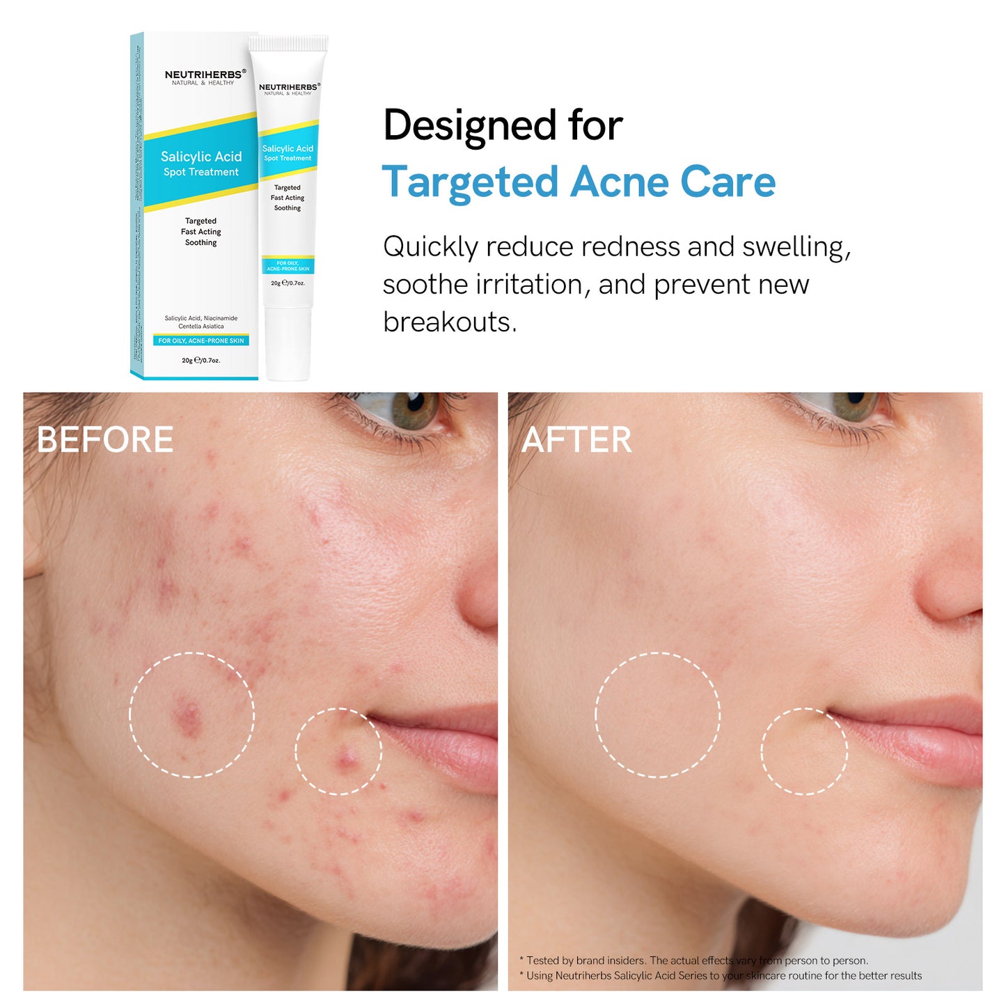 Private Label Salicylic Acid Spot Treatment Gel For Oily, Acne-Prone Skin