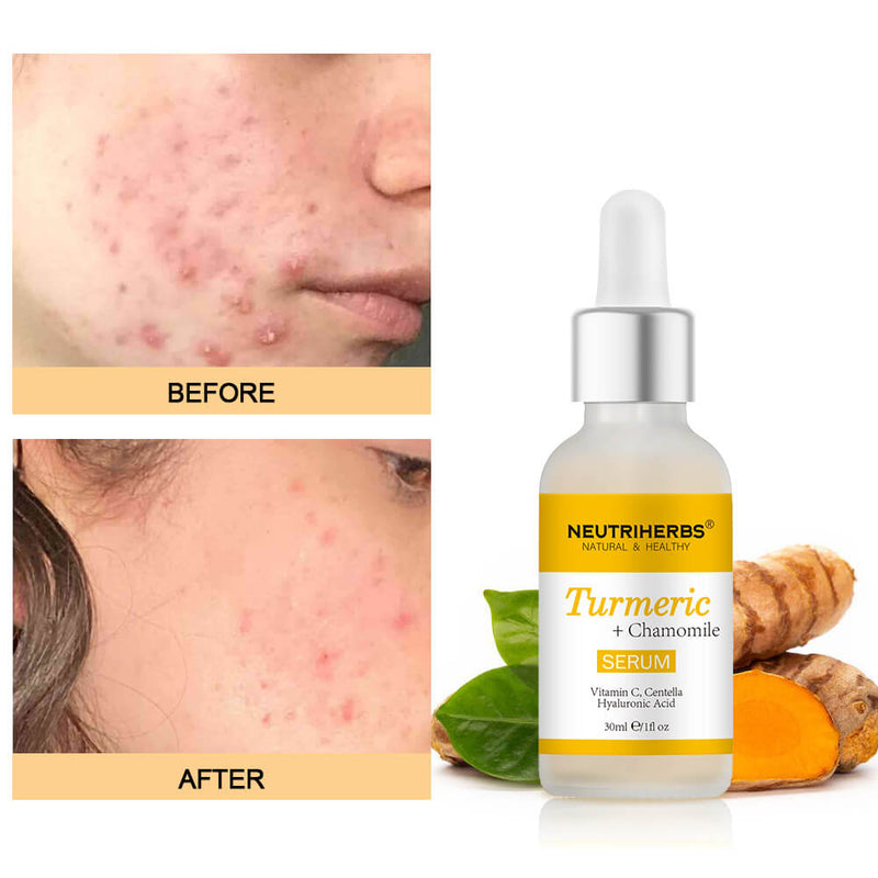 Turmeric serum for ance skin