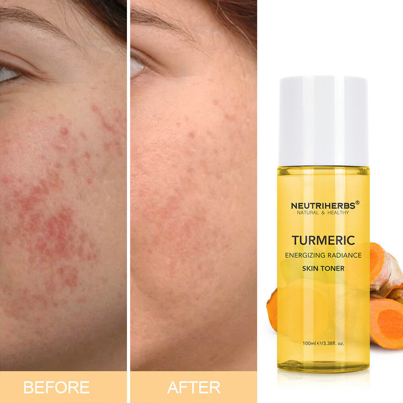 Turmeric Toner For Acne