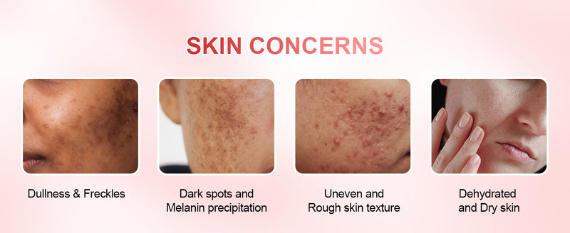 Who suit to use the kojic acid+rose soap? the dullness&freckles