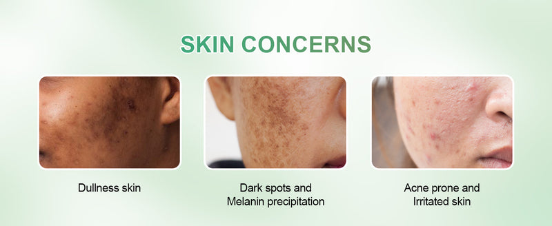 People in acne prone and irritate skin can use ojic acid +tea tree soap , wholesale and private label welcome